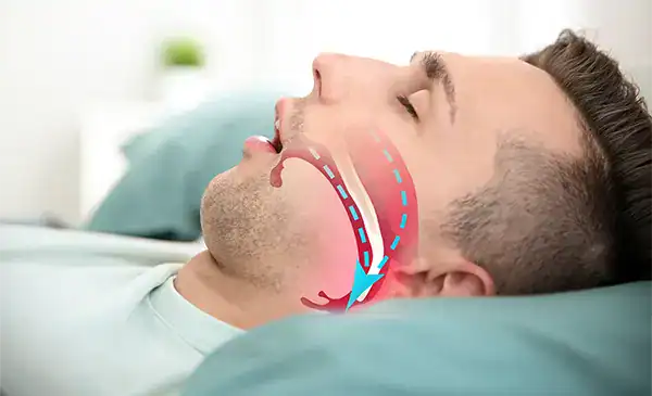 Central and complex sleep apnea airway illustration