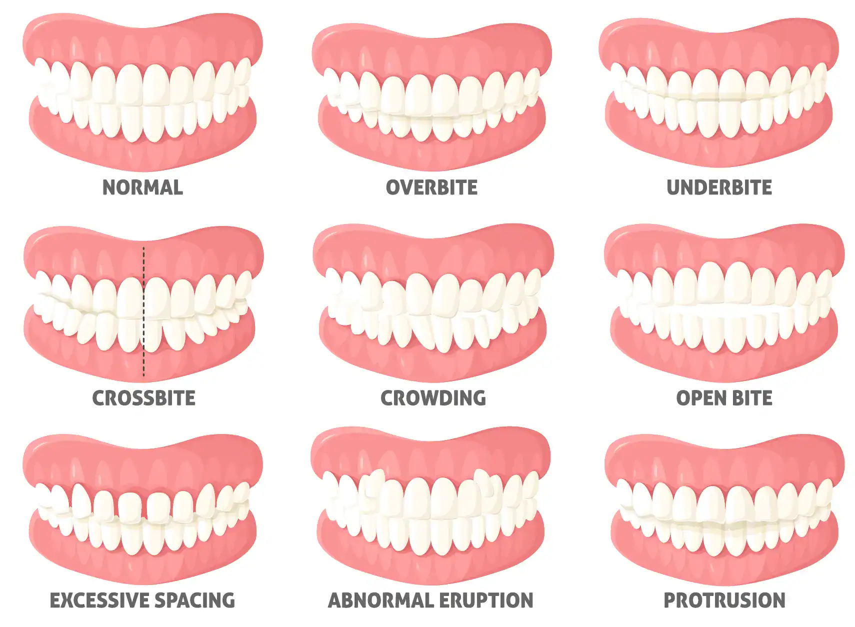 Dental alignment issues treated with orthodontic aligners