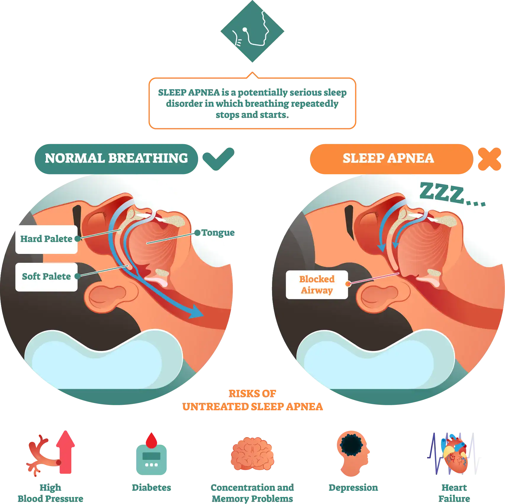 Sleep Apnea