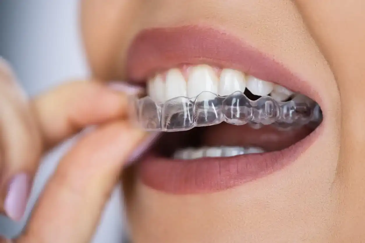 Orthodontic aligner treatment at TMJ Centre of North Texas