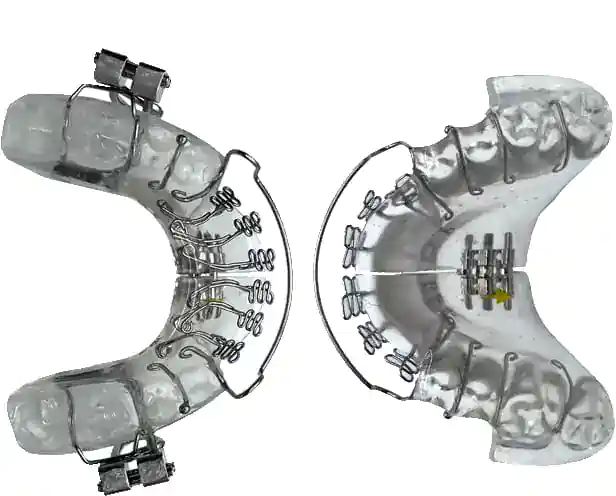 Orthodontic clear aligners