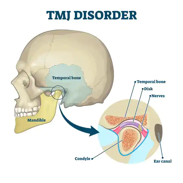 TMJ Disorder